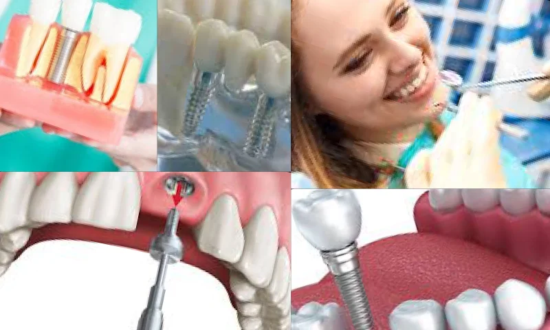 Dental İmplant İle Gülüşünüzü Tasarlıyoruz