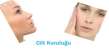 Cilt Kuruluğu Nedeni ve Tedavisi