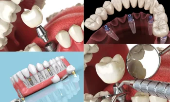 Diş İmplantının Önemi ve Uygulama Aşamaları